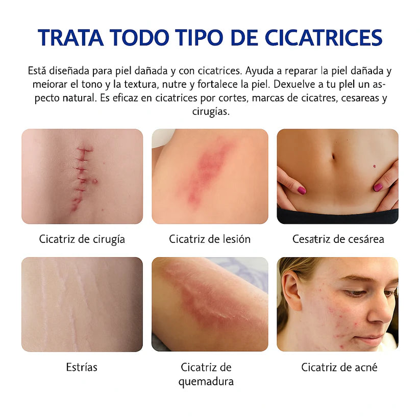 Crema Para Cicatrices Profundas ELAIMEI ORIGINAL® 🔥60% de Descuento🔥 Elimina cicatrices de forma segura✨