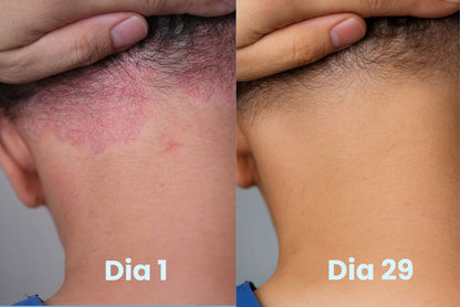 Crema dermatitis Royce Derm ® 🔥60% de Descuento