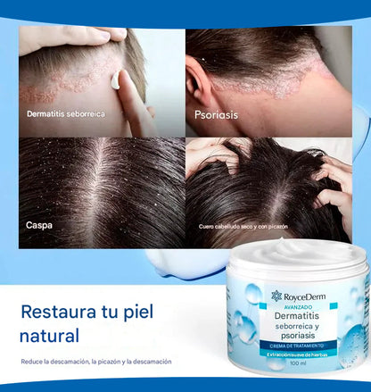 Crema dermatitis Royce Derm ® 🔥60% de Descuento