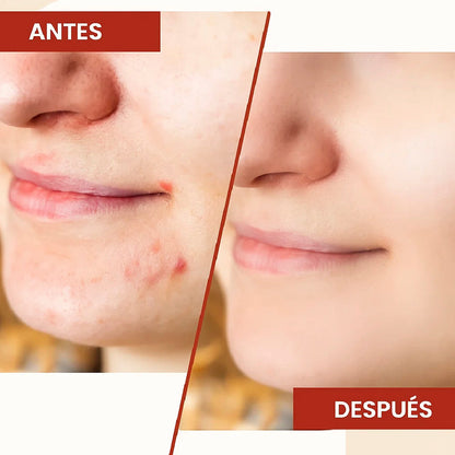 Exfoliante PHANSTA® Elimina manchas, puntos negros zonas oscuras🔥60% de Descuento🔥